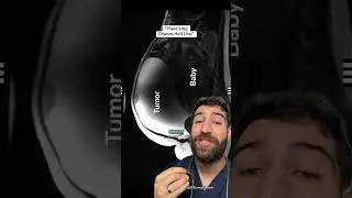 POV: You Thought You Just Had a Tumor