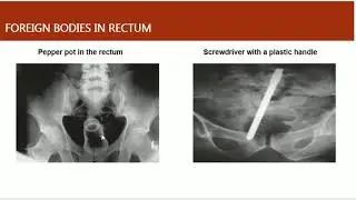 Lecture by Prof Ashfaq Ahmad for MBBS 5th Year on Topic Rectal Injuries and Rectal  Prolapse