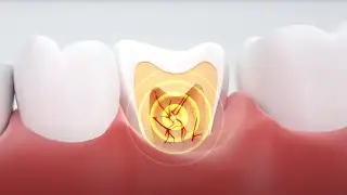 Root Canal Therapy Explained | Pain Relief & Tooth Preservation with Stallings Dental in St. Louis