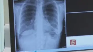ECMO Prevents A Carbon Monoxide Death