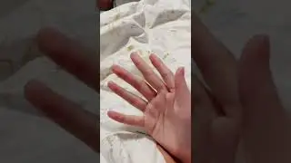 polydactyly