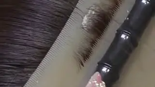 Thick dandruff like fish scales &ndash; removed piece by piece
