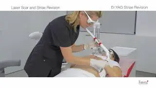 Tratamentul Laser pentru Cicatrici si Vergeturi