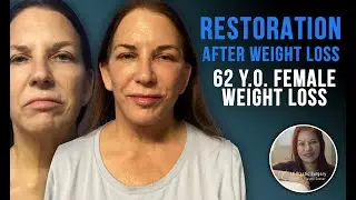 Massive Weight Loss, Total Rejuvenation | 62-Year-Old Patient&rsquo;s Face & Body Transformation