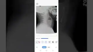 Retropharyngeal space abscess xray