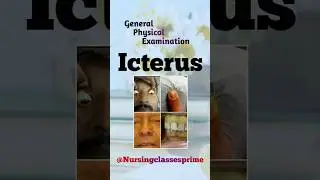 Icterus, general physical examination #shorts #shortvideo #explore