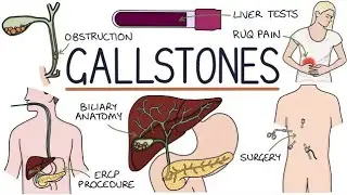 Gallstones (cholelithiasis) causes symptoms , diagnosis treatment #mishalkhanofficial