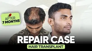 Best Hair Transplant in Delhi (HX-ASDW) | Best Results & Cost of Hair Transplant in Delhi.