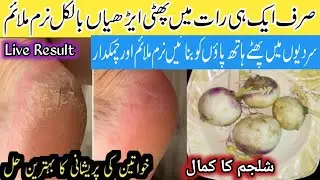 Home Remedies For Creacked Heels | Magical Creacked Heel Remedy Mirha kitchen Hacks | Kitchen Tips 