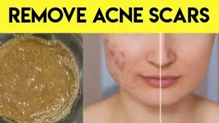 Natural face mask | remove acne pimple scars marks |instant result |in urdu | hindi | @FariaJaved