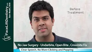 VENLAY&reg; Bite Restoration and Underbite Correction