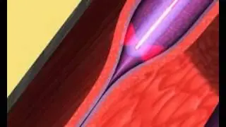 Dr Marek Garbowski Radiofrequency Ablation Technique for Varicose Veins Animation