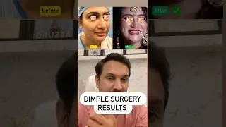Dimple surgery in delhi by Dr Anil Kumar Kaler. Call 8448150908 .. #dimple #dimplesmile #dimplegirl