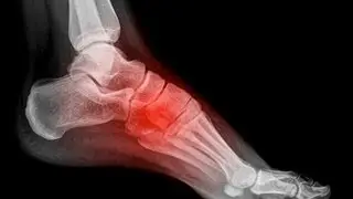 How to Avoid Foot Pain in the Arch | Foot Care