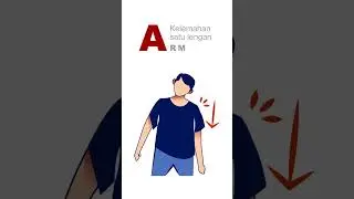 Tanda Awal STROKE ( F A S T ) #SIAGASTROKE