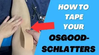 Как зафиксировать болезнь Осгуда-Шлаттерса