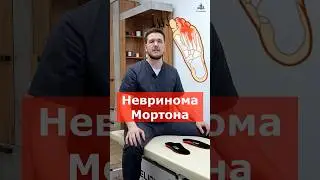 Невринома Мортона. Боль в пальцах стопы | Доктор Финагин