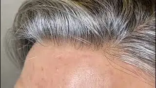 💥 PROTESI CAPELLI SKIN 0.02MM💥 INDETECTABLE HAIR REPLACEMENT SYSTEM 💥 PROTESIS CAPILAR HOMBRE