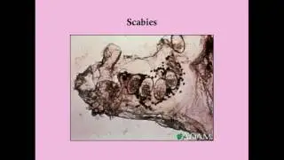 Scabies and Pubic Lice - CRASH! Medical Review Series