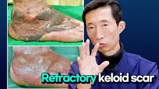 I treated a refractory keloid scar using the Pinholxell method.