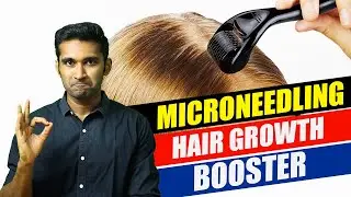 How to do MICRO-NEEDLING at home for HAIR GROWTH?.(தமிழ்) #tamil #haircare #hairgrowth #hairloss