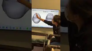 Robert graduates from Cranial Technologies! No more helmet life!