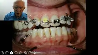 Moving Teeth in Patients Aged 70+