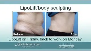 Dr. Darm LipoLift Patient Information