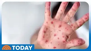 South Carolina Measles Outbreak Doubles in a Week