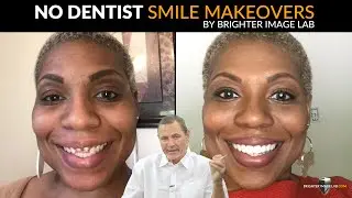 No Dentist Smile Makeovers with Brighter Image Lab Dental Veneers