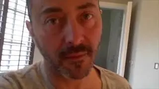 Hair Transplant Megasession (Hairline, Temporal Point, Forelock, Crown) Recovery Journey