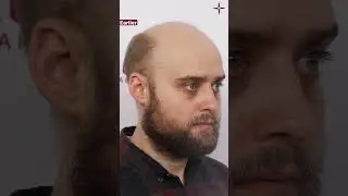 Inspiring Hair Transplant Results: A Journey from United Kingdom to Eugenix!