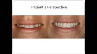 Alternative to Porcelain Veneers and Gum Grafting Surgery - Dental Tutorial - Dr. Elliot Davis