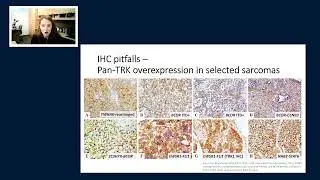 NTRK fusion-positive NSCLC: perspectives from pathology, oncology, and beyond