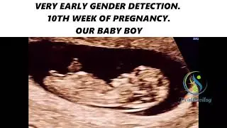 VERY EARLY GENDER DETECTION. 10TH WEEK OF PREGNANCY. OUR BABY BOY #baby #pregnancysymptoms