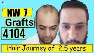 Hair Transplant Result in 2.5 Years, 4104 Grafts, Grade 7 @EugenixHairSciencesofficial  by Expert Surgeon