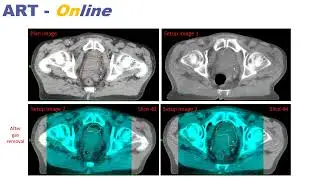 Nathan Corradini: Real-time tumor tracking and adaptive radiotherapy at Gruppo Ospedaliero Moncucco