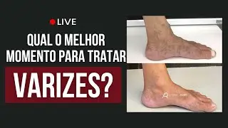 Qual o melhor momento para tratar suas varizes?