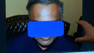 The Art of Hair Transplant Restoration | 1-Year Natural Zigzag Hairline Result – Dr. John Diep