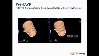 Go Without Contrast and Use TEE - Mani Vannan, MD