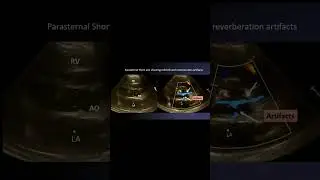 Annoying Reverberation Artefacts on Color Doppler