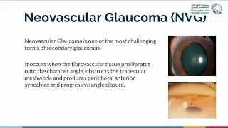 Neovascular Glaucoma