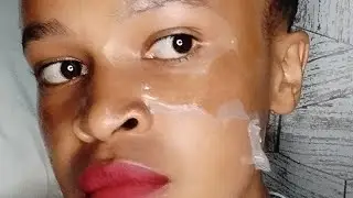 Skin peeling after sunburn