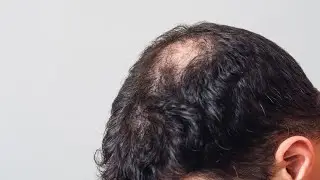 Transplant for the crown without Finasteride.