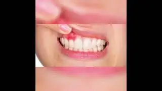 Тиш милкларининг шамоллаши
