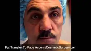 Detroit Facial Fat Transfer by Dr. Mark Berkowitz