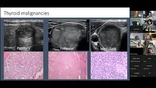 12 7 Thyroid Nodules   Dr  Endo