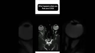 WHAT HAPPENS WHEN YOU RUB YOUR EYES?