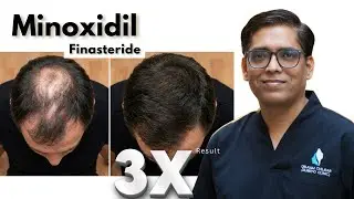 Minoxidil and Finasteride अचानक बंद मत करें!