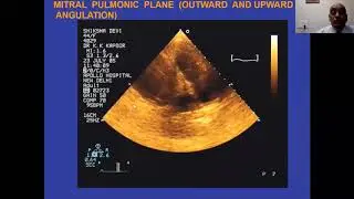 Philips Echo Webinar Series 2D Echo Basics by Dr  K  K  Kapur, Indraprastha Apollo, New Delhi